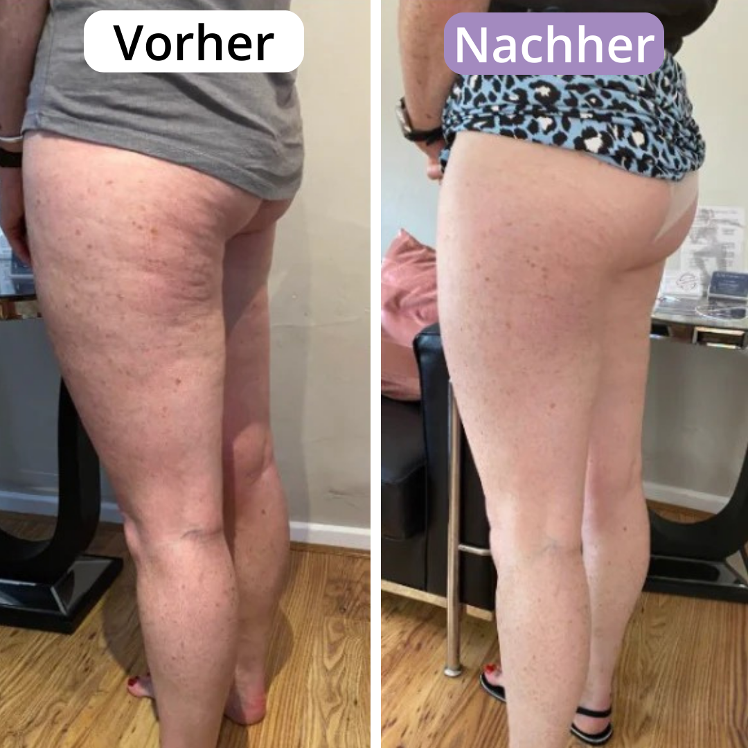 AveraSkin - Das Massagegerät gegen Cellulite