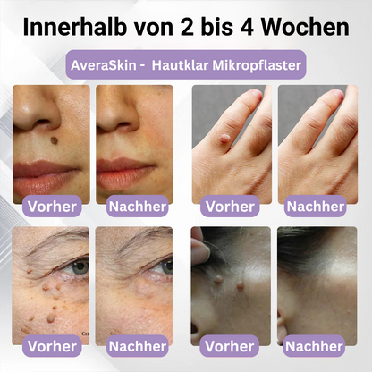AveraSkin -  Hautklar Mikropflaster