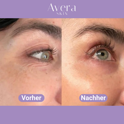 AveraSkin - Hyaluron Mikronadeln Augenpads
